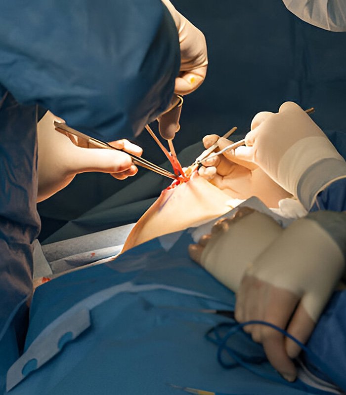 hernia