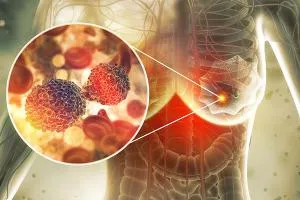 Breast cancer surgery