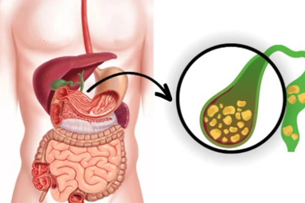 Gallbladder Surgery