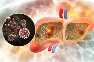 Lap liver abscess drainage