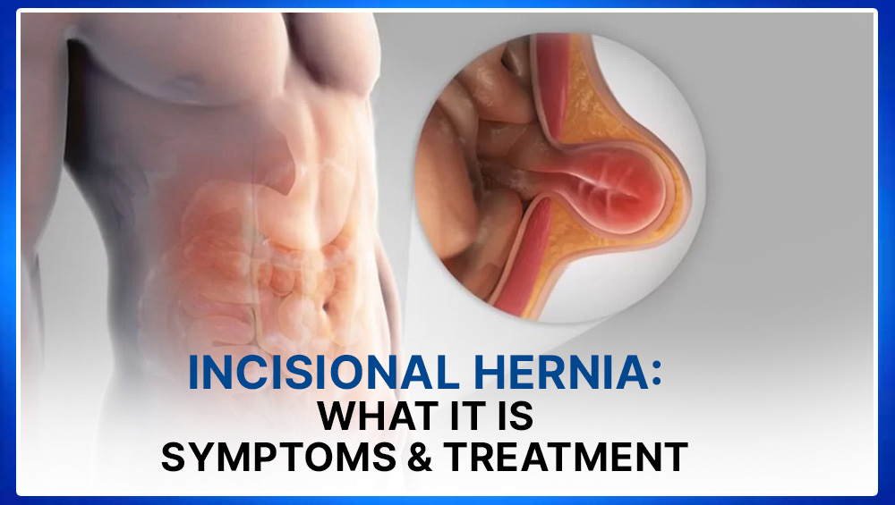 Incisional Hernia